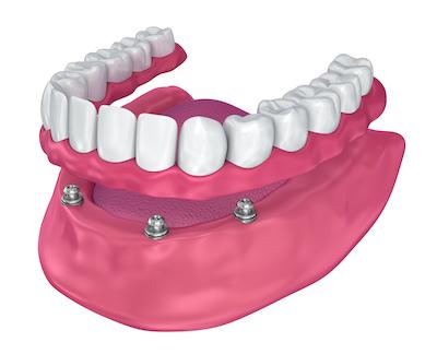 all on four dental implants in barrie