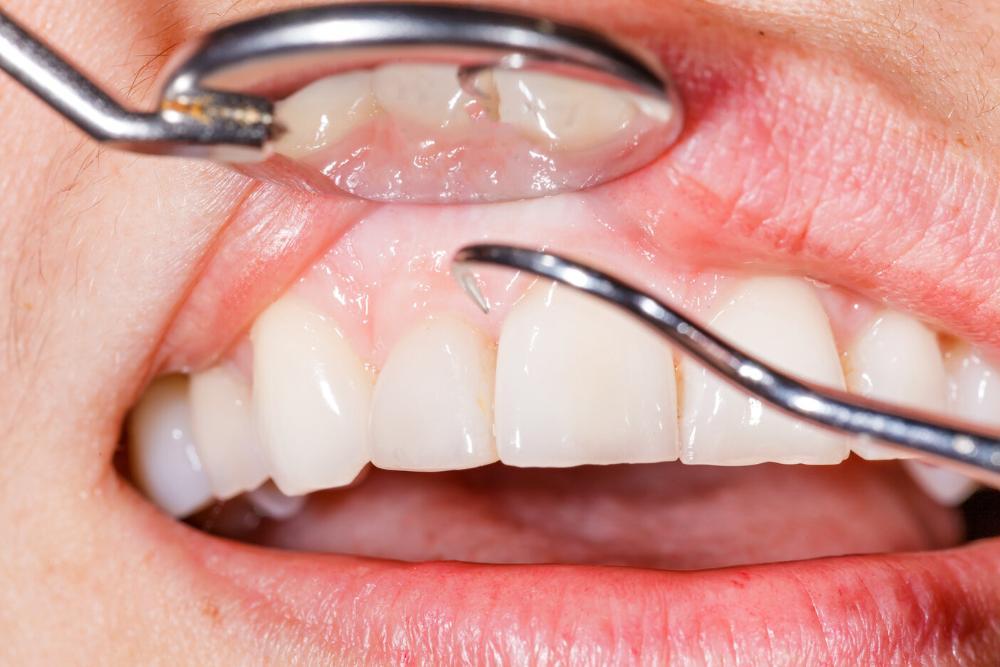 man in dental chair smiling before gum surgery in Barrie ON