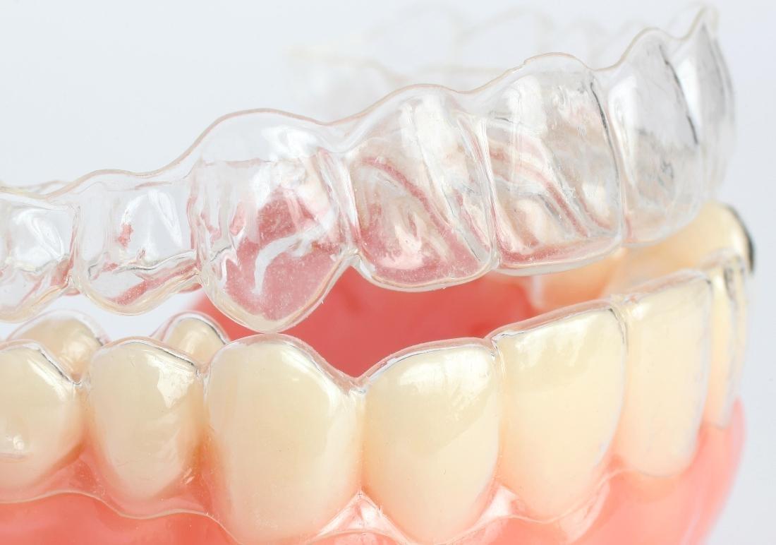 Barrie ON Dentist How Invisalign Works and Why We It