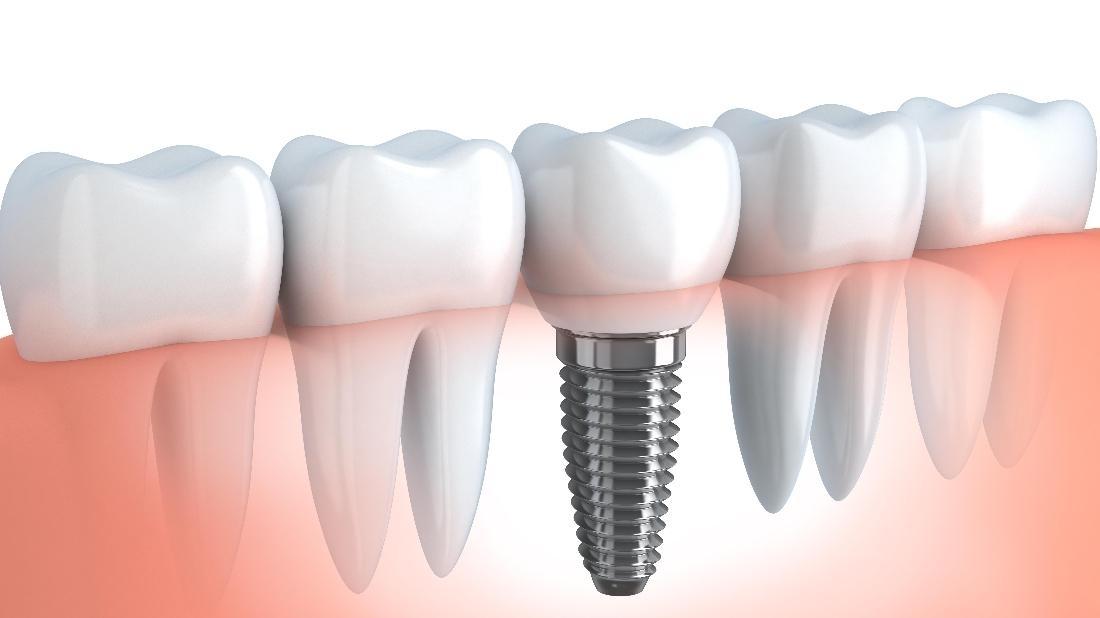 Barrie Dentist Why Dental Implants Are a Smart Investment