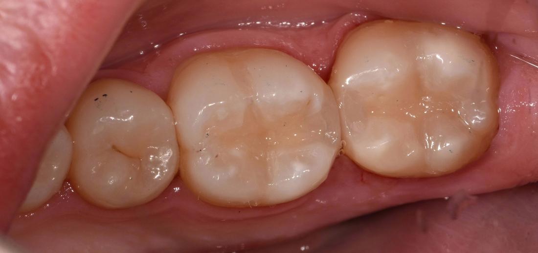 After photo of new tooth filling | Dentist Barrie ON
