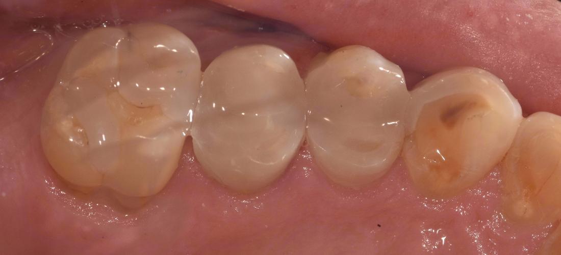 back teeth after new white fillings