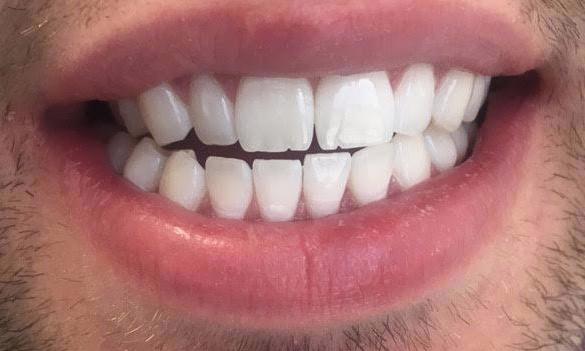 Smile after zoom whitening 