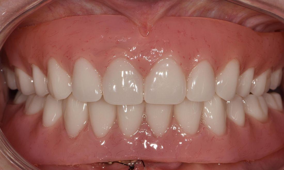 After photo of new dentures 