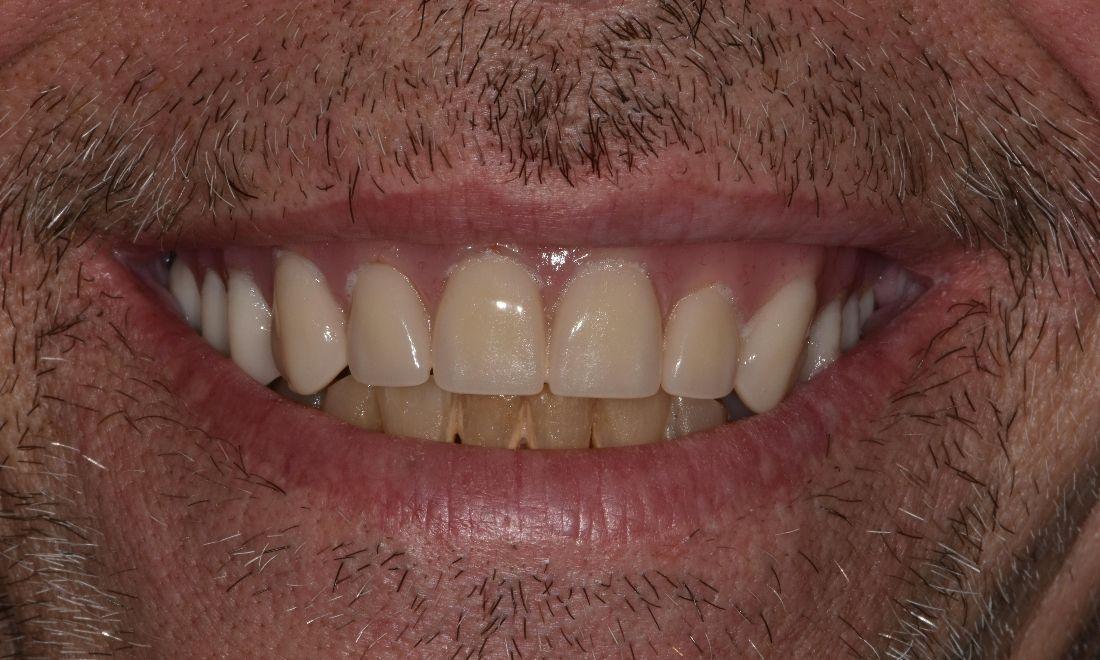 After full mouth restoration in barrie