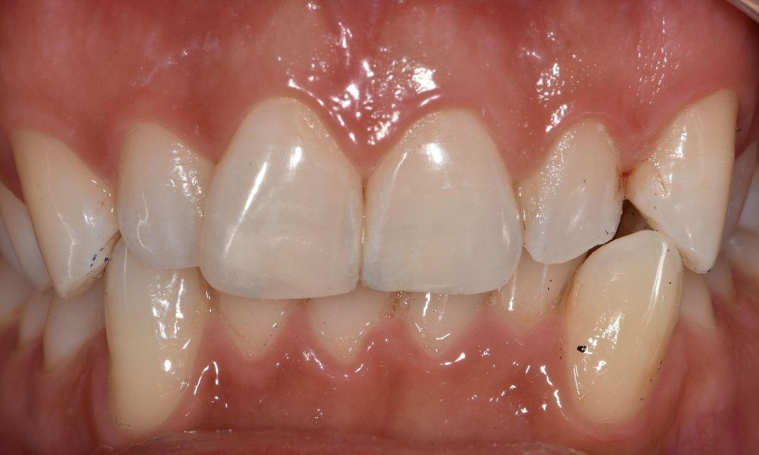 After photo of broken teeth fixed with resin | Barrie ON Dentist
