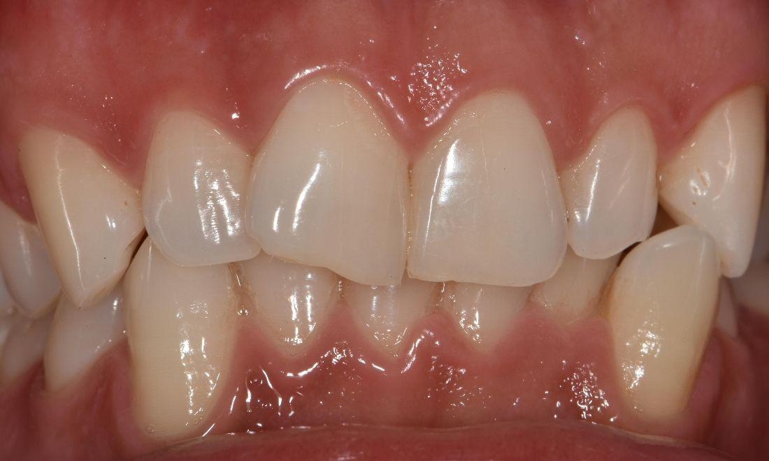 Close up of broken front tooth before dental bonding