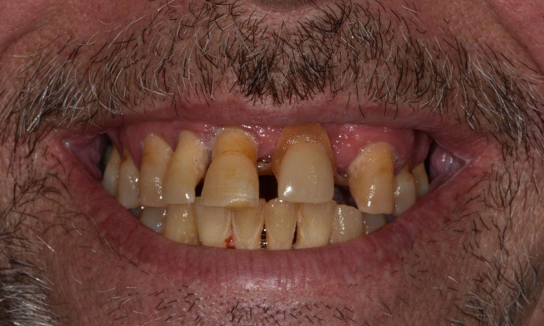 Before full mouth restoration in Barrie