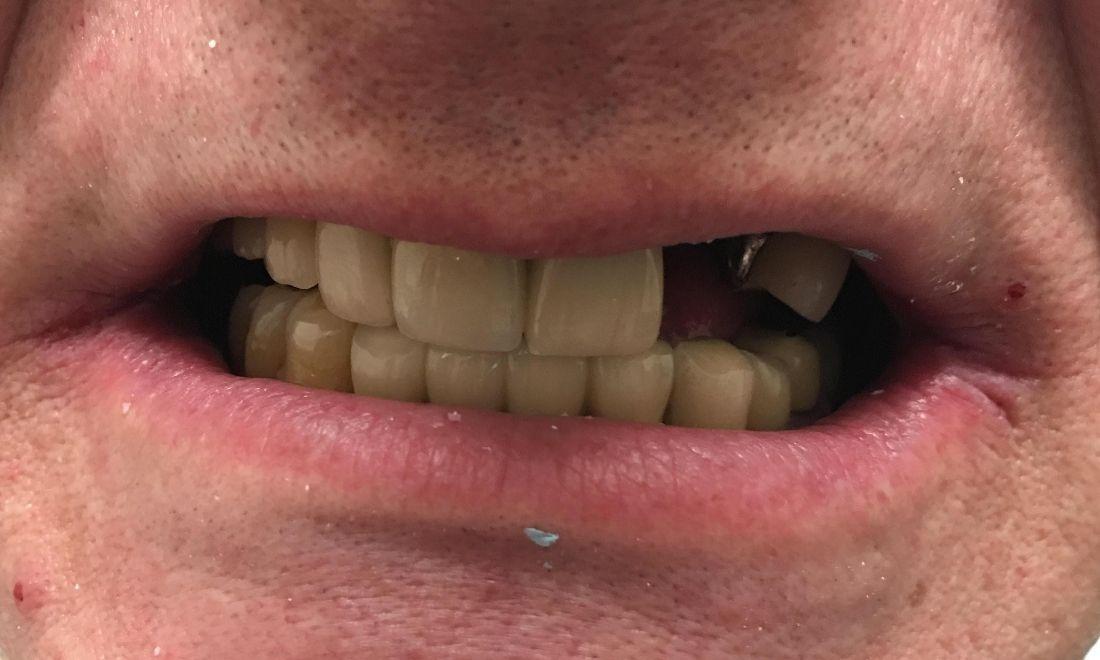 Close up of smile missing teeth before dental implants