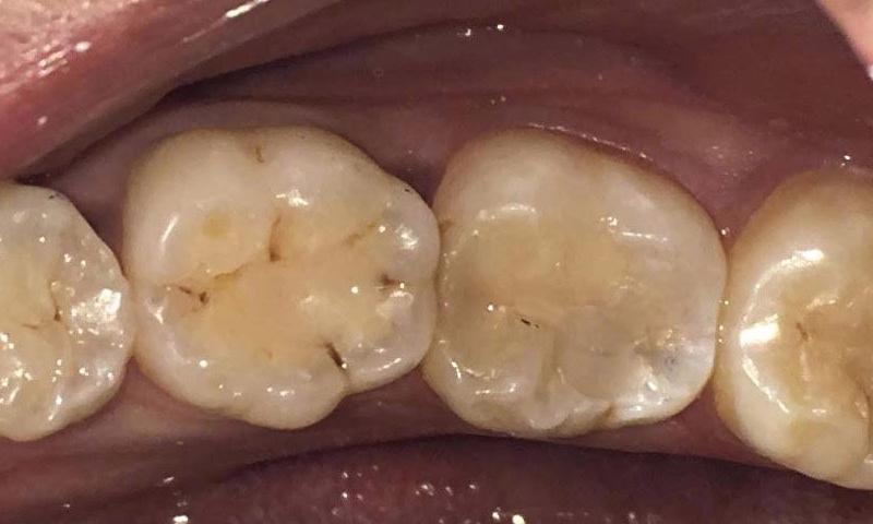 Old tooth fillings before new composite fillings
