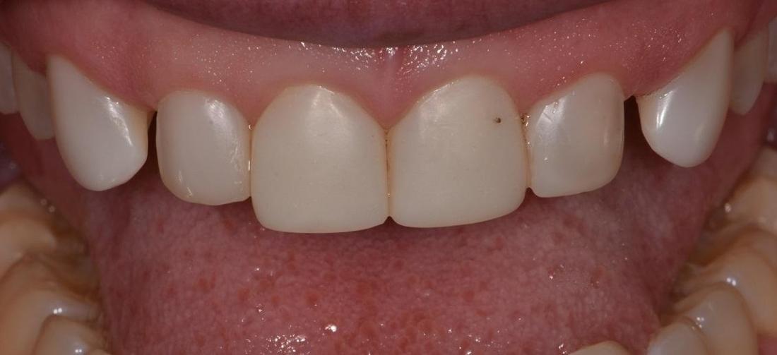 Close up of smile before veneers | Park Place Dental