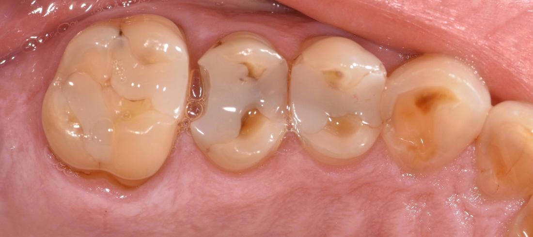 Broken teeth with undesirable contour between teeth before filling