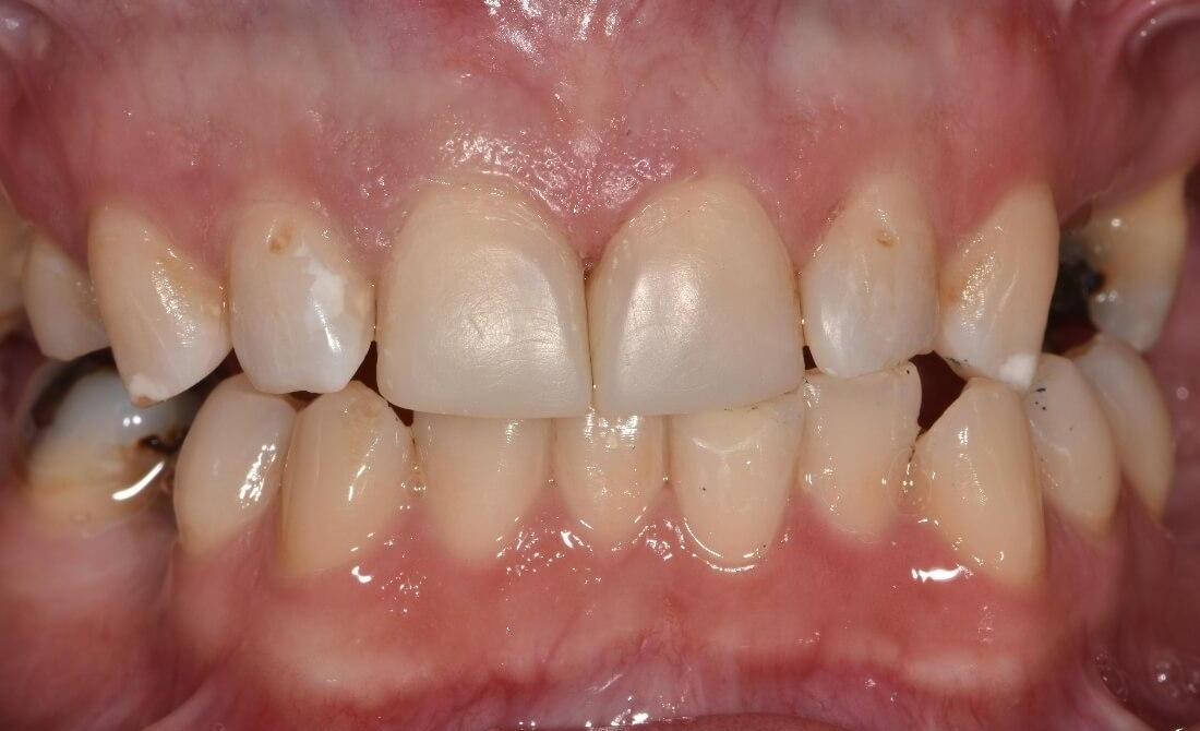 tooth-coloured filling material used to restore chipped front tooth
