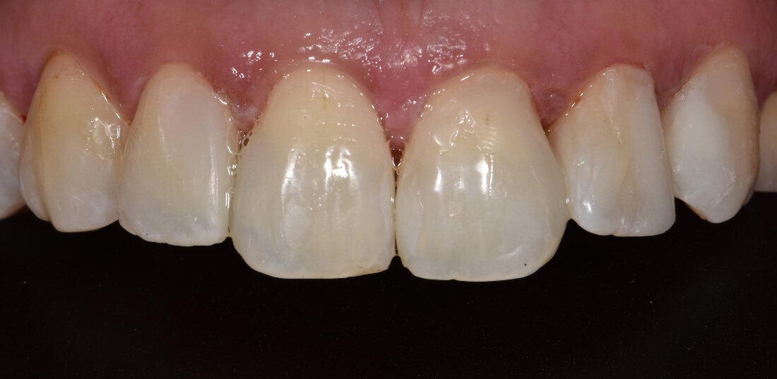 Close up of teeth after front teeth makeover