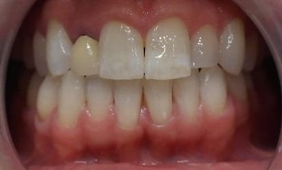 small anterior tooth before crown