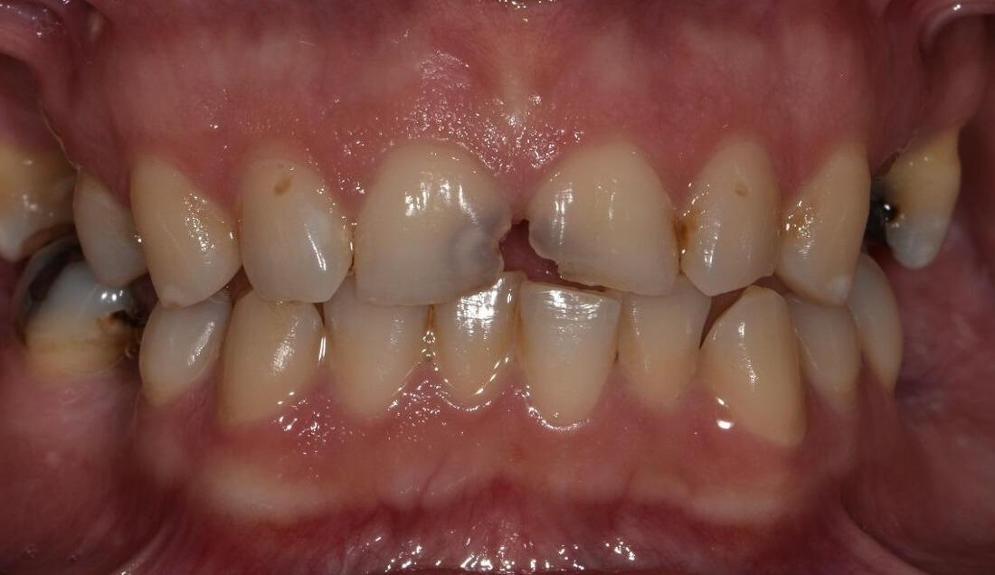 chipped front teeth before restoration