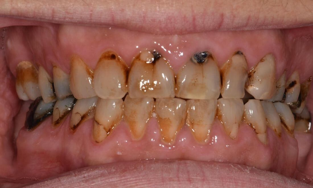 Cavities and decay on teeth before dental cleaning