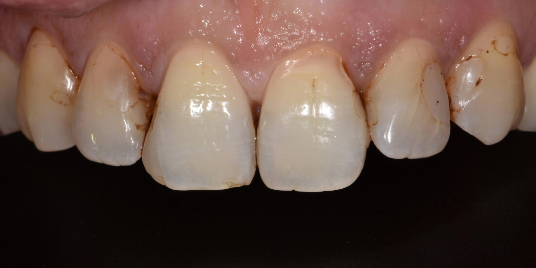 Close up of teeth with defected margin | Park Place Dental