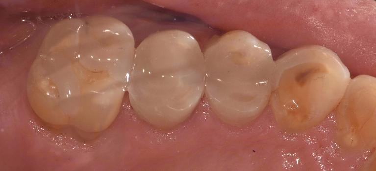 White-Fillings-After-Image