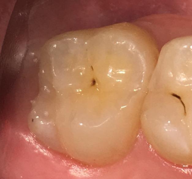 after White resin on tooth to fix fissures