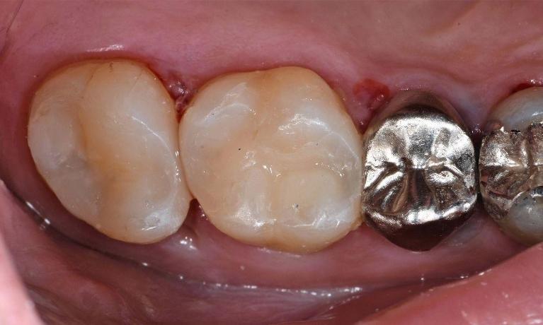 teeth after White filling replaced old silver filling