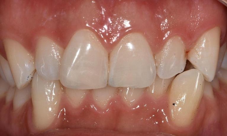 After photo of broken teeth fixed with resin | Barrie ON Dentist