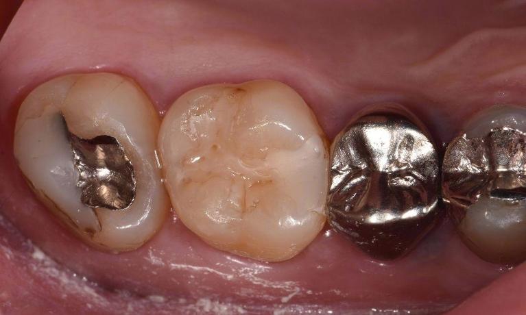 Silver fillings in tooth before white fillings