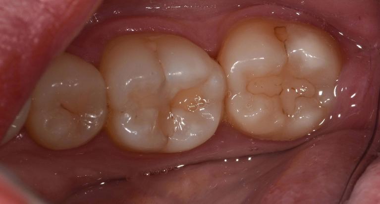 Close up of tooth before filling replacement | Barrie ON Dentist
