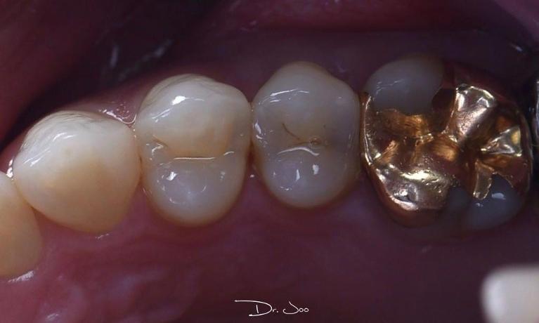 Composite-Restorations-Before-Image