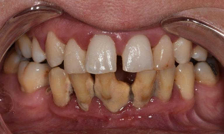 Full-Mouth-Rehabilitation-Using-Dentures-Before-Image