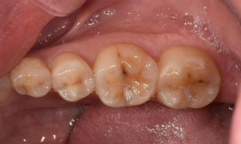 Tooth-Coloured-Fillings-Before-Image