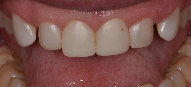Close up of smile before veneers | Park Place Dental