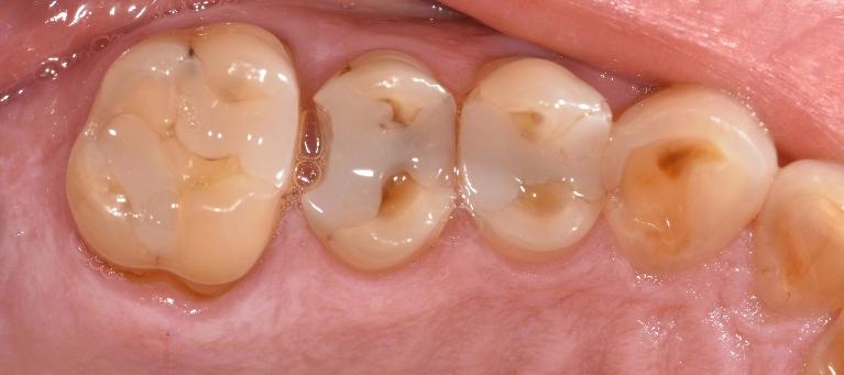 White-Fillings-Before-Image