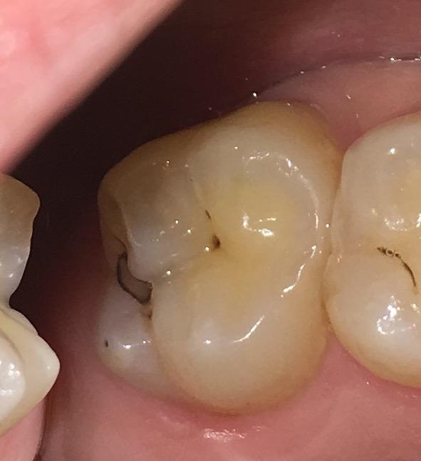 Fissures in molars before tooth coloured restorations