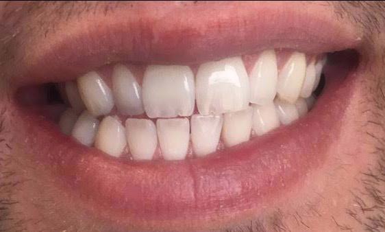 Before photo of smile before whitening