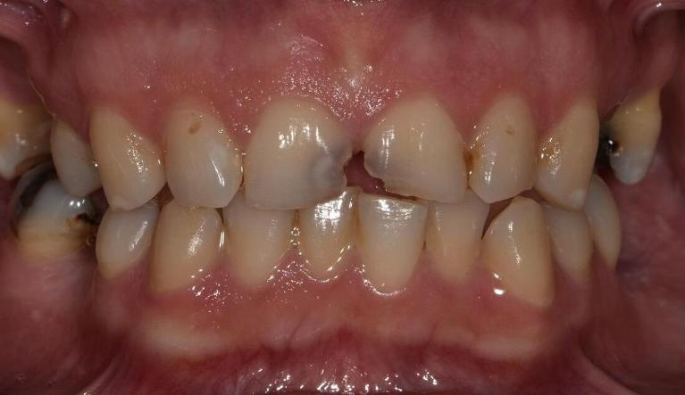 Anterior-Teeth-Restored-With-Tooth-Colour-Restorations-Before-Image