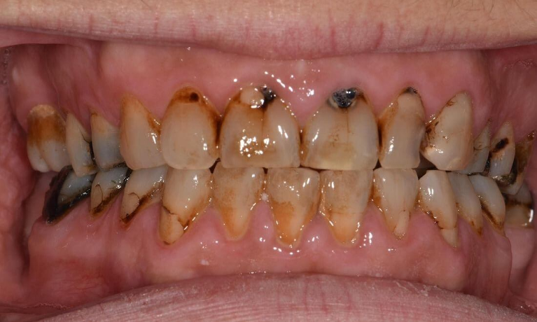 Basic-Dental-Cleaning-Before-Image