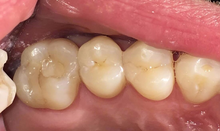 Before photo of failing tooth filling | Dentist Barrie ON